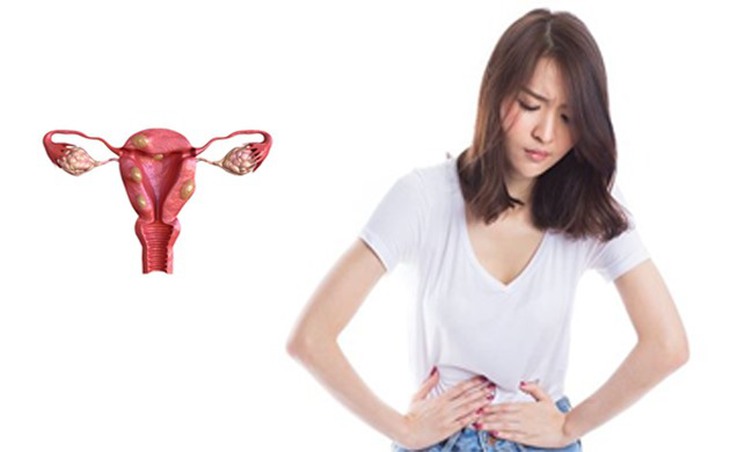 Hiếm khi u xơ tử cung có thể gây ra cơn đau cấp tính.