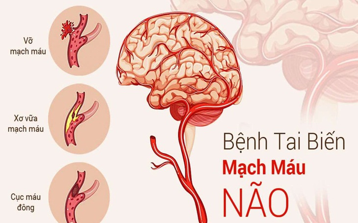 Mắc COVID-19 và nguy cơ đột quỵ não cấp
