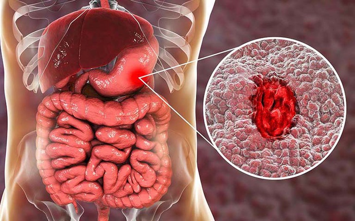 Xuất huyết dạ dày và cách phòng ngừa