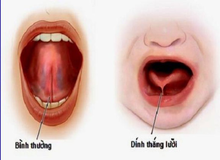 Hình ảnh hãm lưỡi (thắng lưỡi) bình thường và hãm lưỡi (thắng lưỡi) ngắn.