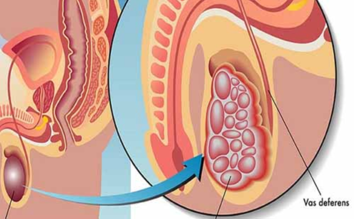 Vôi hóa tinh hoàn có nguy hiểm không? - Ảnh 2. Vôi hóa tinh hoàn có nguy hiểm không? - Ảnh 2.