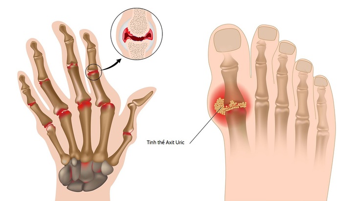 Người cao tuổi bị bệnh gút nên ăn gì và tránh ăn gì? - Ảnh 2.