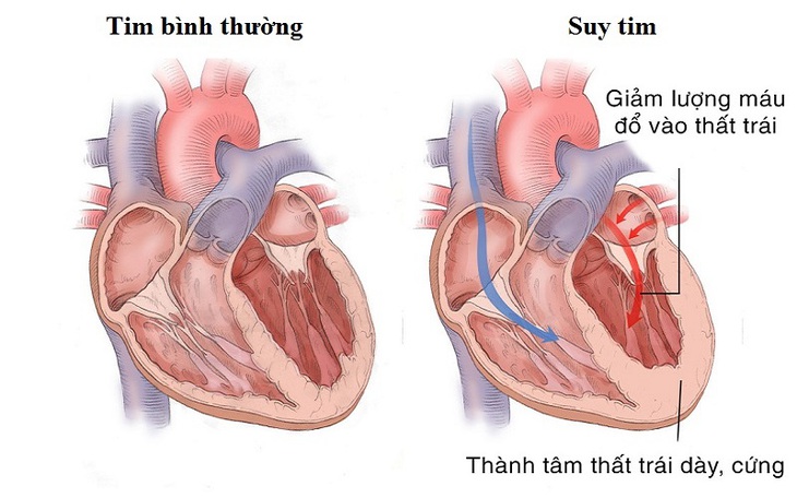 Ai dễ bị suy tim?- Ảnh 1. Ai dễ bị suy tim?- Ảnh 1.