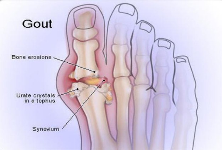 Bệnh gút là một loại viêm khớp do sự hình thành các tinh thể axit uric trong khớp và gây đau đớn.jpg 
