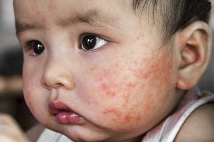 Làm gì để tránh cho con các đợt viêm da cơ địa cấp? - Ảnh 2.