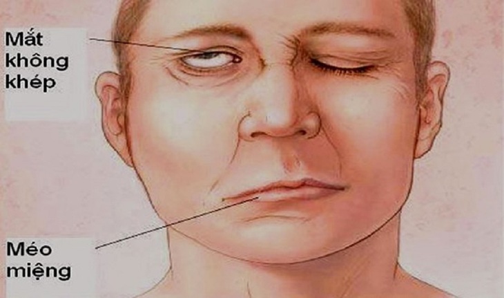 Liệt nửa mặt do lạnh nếu không điều trị có thể tự hết không? - Ảnh 1.