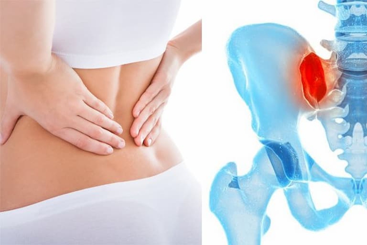 Viêm khớp cùng chậu có nguy hiểm? - Ảnh 2.