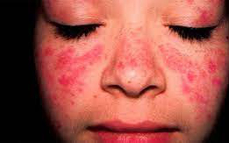 Người bệnh Lupus ban đỏ đã có thêm một lựa chọn điều trị mới