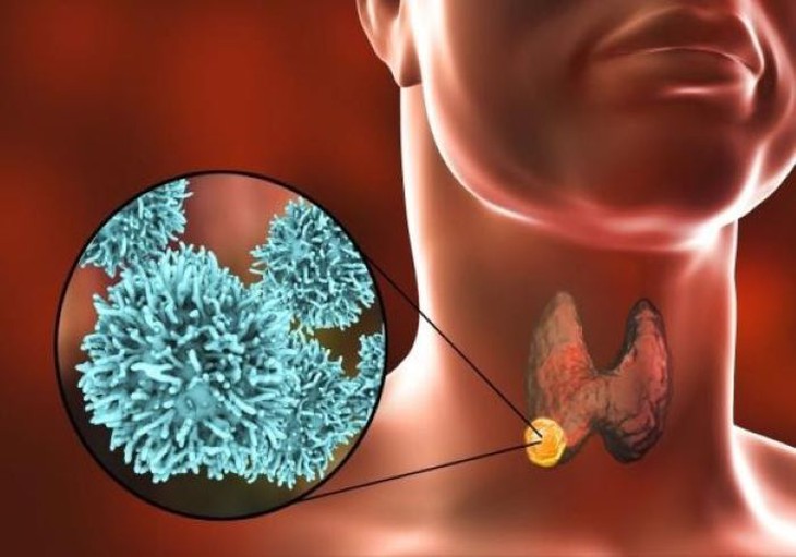 Có điều trị ung thư tuyến giáp tiến triển bằng thuốc nhắm trúng đích không? - Ảnh 4. Có điều trị ung thư tuyến giáp tiến triển bằng thuốc nhắm trúng đích không? - Ảnh 4.