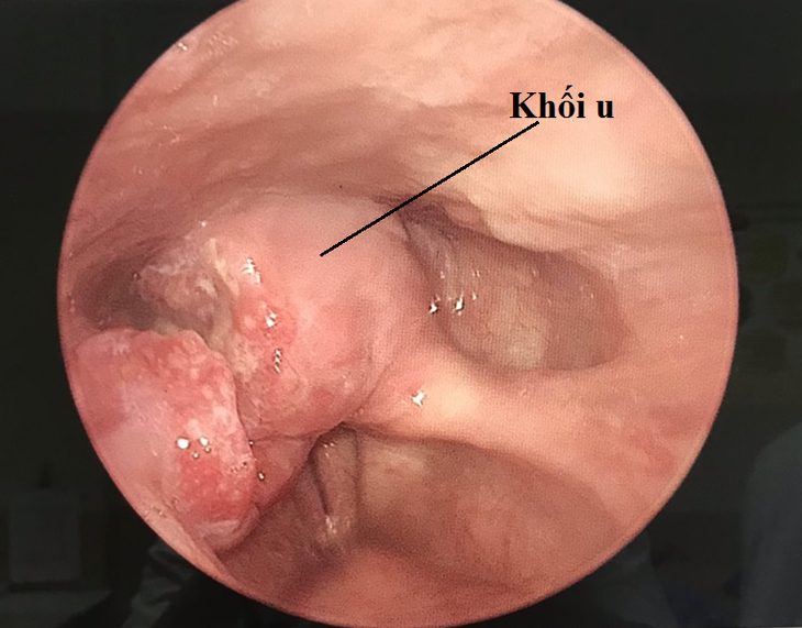 Ung thư hạ họng, phòng ngừa sớm khi có thể - Ảnh 2.