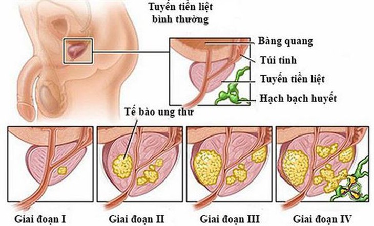 Mới, phẫu thuật nội soi trước phúc mạc điều trị ung thư tuyến tiền liệt - Ảnh 3. Mới, phẫu thuật nội soi trước phúc mạc điều trị ung thư tuyến tiền liệt - Ảnh 3.