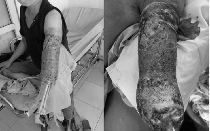Cánh tay trái thối hoàn toàn do đắp thuốc Nam chữa rắn cắn