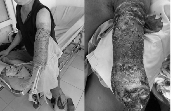 Mất bàn tay do tự ý đắp thuốc Nam chữa rắn cắn - Ảnh 1.