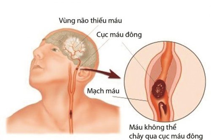 Mắc COVID-19 và nguy cơ đột quỵ não cấp - Ảnh 2.