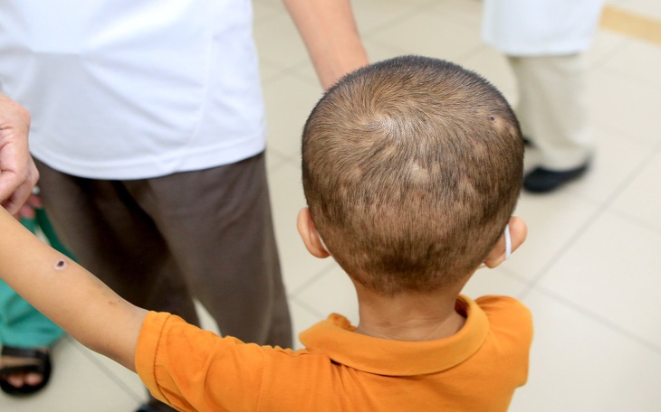 Trèo cây hái nhãn, bé trai bị ong đốt túi bụi 50 vết