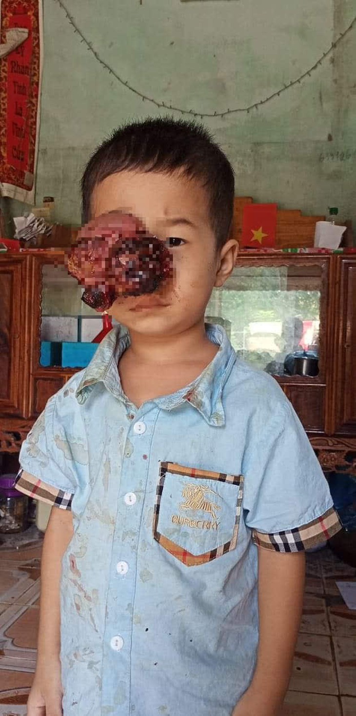 Đau lòng nhìn em bé dân tộc bị khối u đẩy lồi mắt ra ngoài, nguy cơ nhiễm trùng cao không có tiền chữa bệnh - Ảnh 2.