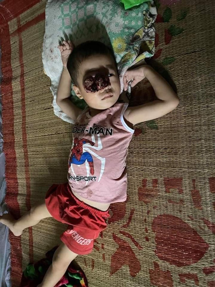 Đau lòng nhìn em bé dân tộc bị khối u đẩy lồi mắt ra ngoài, nguy cơ nhiễm trùng cao không có tiền chữa bệnh - Ảnh 3.
