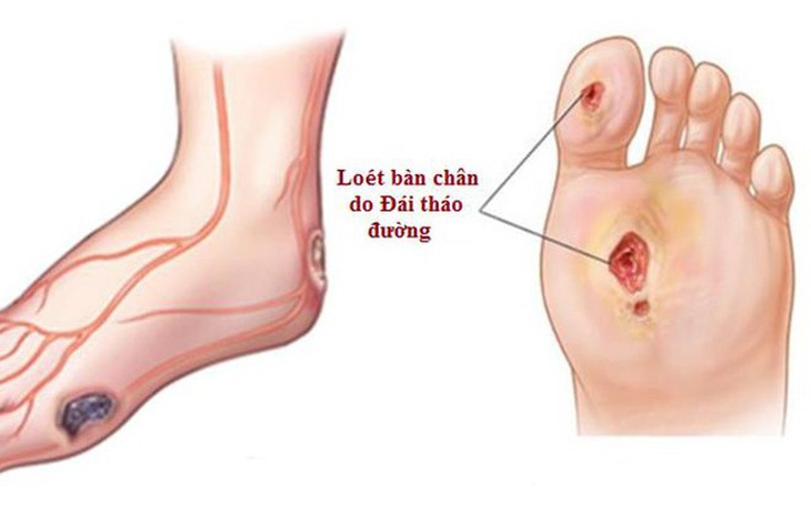 Bảo tồn bàn chân cho người bệnh Lào bị nhiễm trùng do đái tháo đường - Ảnh 4.
