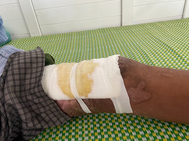 Đắp thuốc nam chữa bỏng, sai lầm tai hại - Ảnh 2. Đắp thuốc nam chữa bỏng, sai lầm tai hại - Ảnh 2.