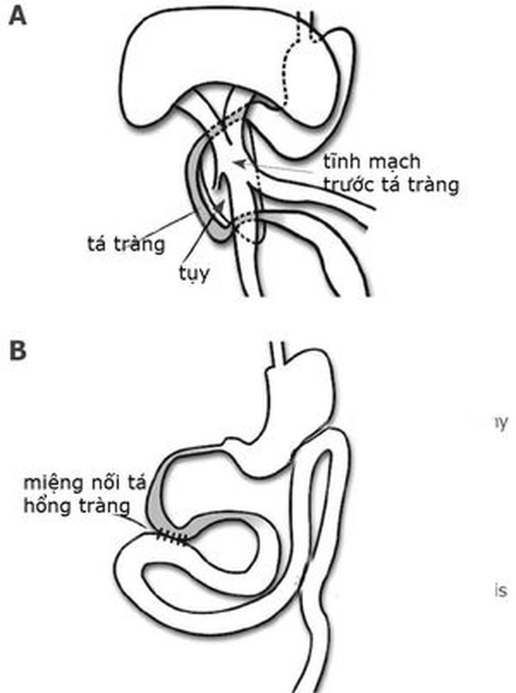 Tắc tá tràng ở trẻ sơ sinh - Ảnh 4.