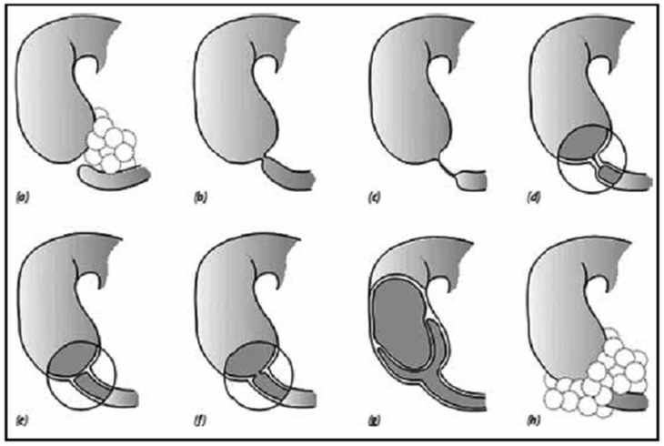 Tắc tá tràng ở trẻ sơ sinh - Ảnh 3.