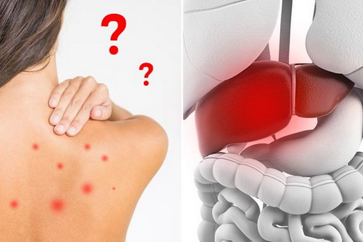 Gan yếu do dùng thuốc dài ngày. Đừng chủ quan! - Ảnh 2.