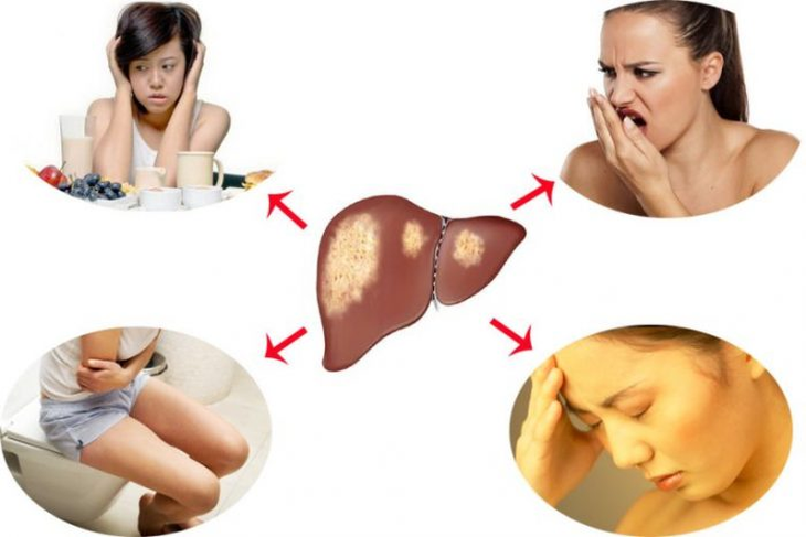 Bệnh lao và chức năng gan suy giảm - Nguyên nhân và giải pháp - Ảnh 2. Bệnh lao và chức năng gan suy giảm - Nguyên nhân và giải pháp - Ảnh 2.