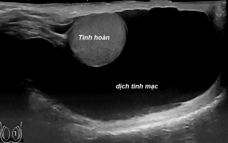 Nam giới căng tức vùng kín, cảnh giác với tràn dịch màng tinh hoàn - Ảnh 4. Nam giới căng tức vùng kín, cảnh giác với tràn dịch màng tinh hoàn - Ảnh 4.