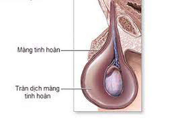 Nam giới căng tức vùng kín, cảnh giác với tràn dịch màng tinh hoàn - Ảnh 3. Nam giới căng tức vùng kín, cảnh giác với tràn dịch màng tinh hoàn - Ảnh 3.