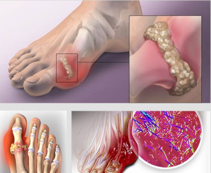 Bệnh gút và những điều bạn cần biết - Ảnh 1.