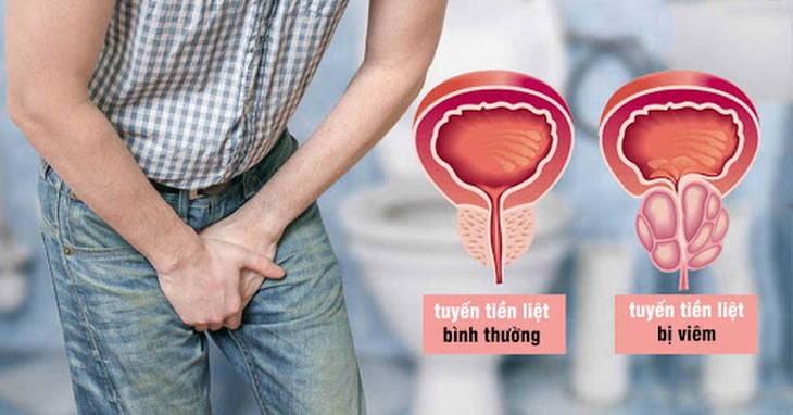 Tăng sinh lành tính tuyến tiền liệt cần phân biệt với ung thư và bệnh gì? - Ảnh 1.
