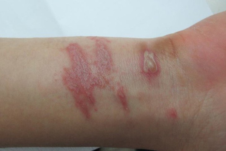 Nhận diện và xử trí đúng cách khi bị viêm da do độc tố của kiến ba khoang - Ảnh 3. Nhận diện và xử trí đúng cách khi bị viêm da do độc tố của kiến ba khoang - Ảnh 3.