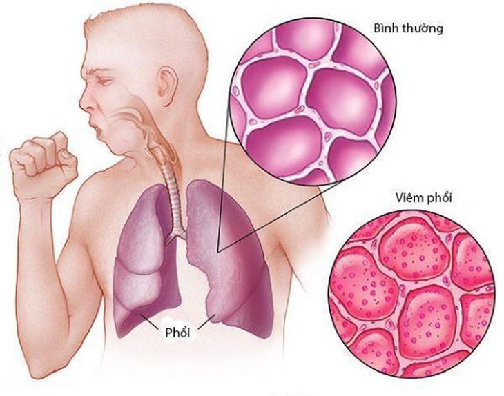 Bài thuốc cổ phương trị triệu chứng COVID-19 kéo dài - Ảnh 1.