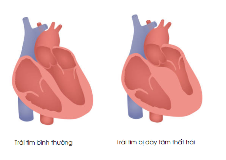Dày thất trái - Căn bệnh nguy hiểm thường gặp ở người tăng huyết áp - Ảnh 1.