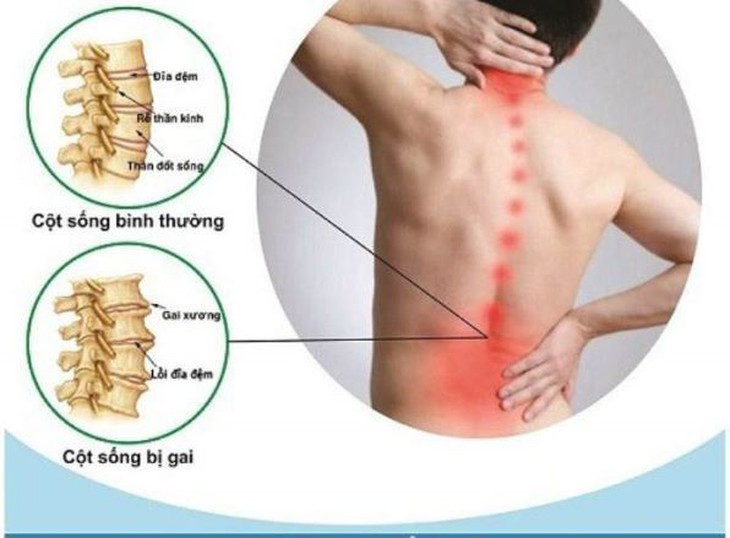 Các động tác giúp giảm đau do thoái hóa cột sống thắt lưng và cổ - Ảnh 1. Các động tác giúp giảm đau do thoái hóa cột sống thắt lưng và cổ - Ảnh 1.