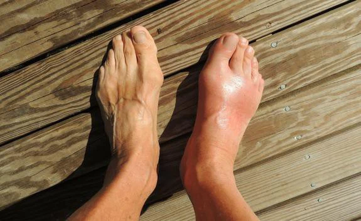 Đại học Nam Cần Thơ nghiên cứu thành công sản phẩm hỗ trợ giảm acid uric và viêm khớp do gout - Ảnh 1. Đại học Nam Cần Thơ nghiên cứu thành công sản phẩm hỗ trợ giảm acid uric và viêm khớp do gout - Ảnh 1.