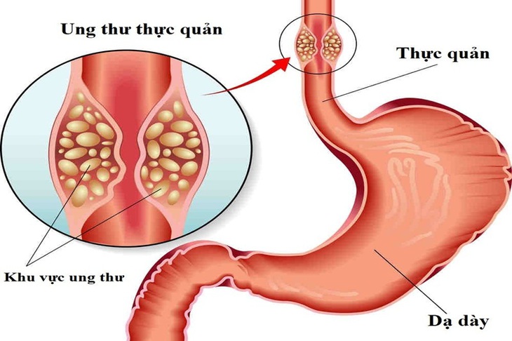 Dinh dưỡng lành mạnh ngăn ngừa ung thư thực quản - Ảnh 1.