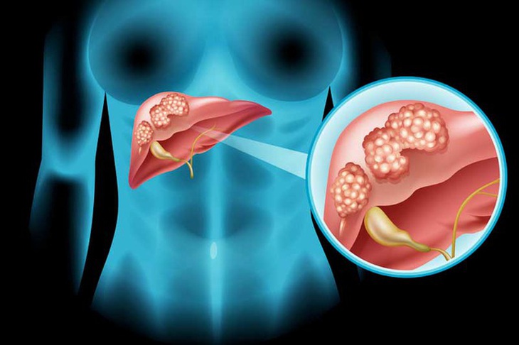 Viêm gan virus B và dự phòng ung thư gan - Ảnh 2.