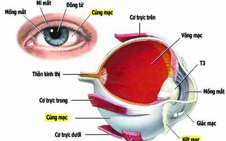 Đỏ và đau nhức mắt dữ dội - Cẩn thận bị viêm củng mạc