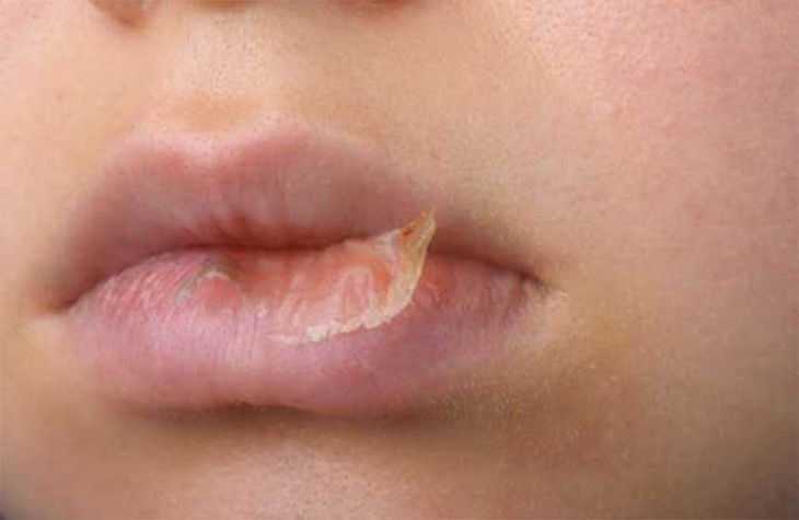 Chàm môi có thể biểu hiện mức độ nhẹ bằng triệu chứng khô, tróc vảy, nứt nẻ môi. Chàm môi có thể biểu hiện mức độ nhẹ bằng triệu chứng khô, tróc vảy, nứt nẻ môi.