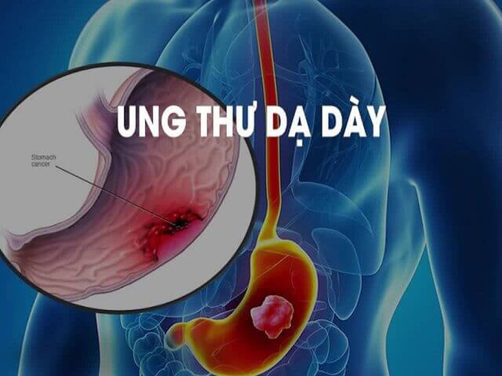 Ung thư dạ dày sớm có biểu hiện như thế nào? - Ảnh 2.