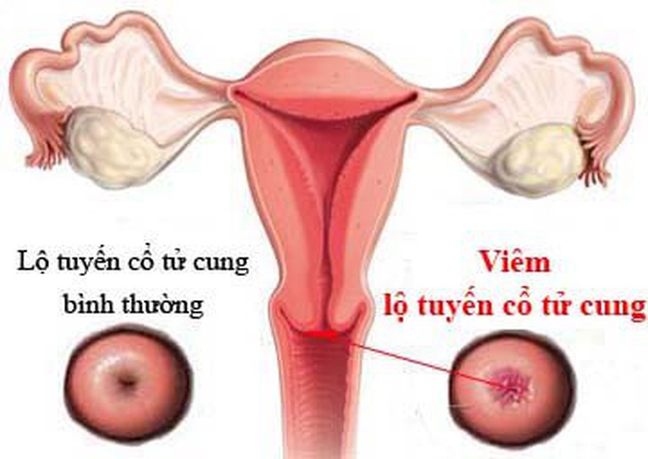 Viêm lộ tuyến cổ tử cung - các triệu chứng, nguyên nhân và cách điều trị - Ảnh 2.