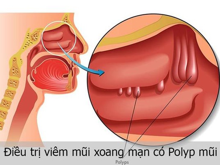 Sử dụng sóng siêu âm điều trị viêm mũi xoang mạn tính - Ảnh 3. Sử dụng sóng siêu âm điều trị viêm mũi xoang mạn tính - Ảnh 3.