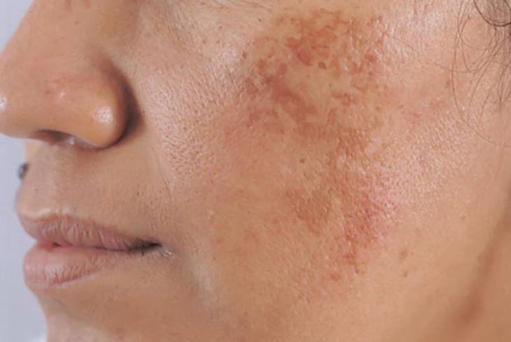 Trào lưu đắp đu đủ xanh trị nám, tàn nhang đang được nhiều Tiktoker lăng xê "lợi hại" đến đâu? - Ảnh 6. Trào lưu đắp đu đủ xanh trị nám, tàn nhang đang được nhiều Tiktoker lăng xê "lợi hại" đến đâu? - Ảnh 6.