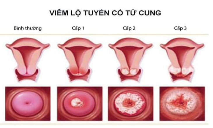 Viêm lộ tuyến cổ tử cung - bệnh phụ khoa không thể chủ quan - Ảnh 3.