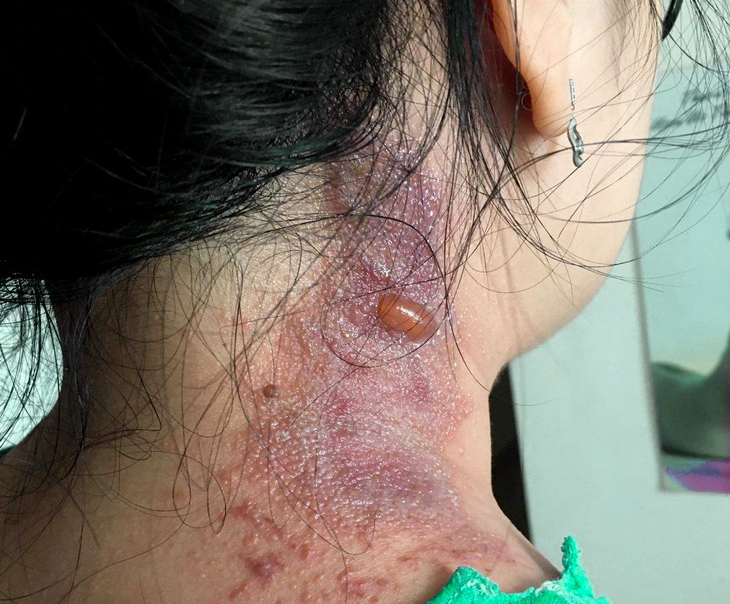 Nhiều người viêm da do kiến ba khoang bị chẩn đoán nhầm bệnh Zona - Ảnh 1. Nhiều người viêm da do kiến ba khoang bị chẩn đoán nhầm bệnh Zona - Ảnh 1.