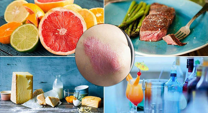 Những thực phẩm nên ăn và nên tránh khi bị vảy nến - Ảnh 1.