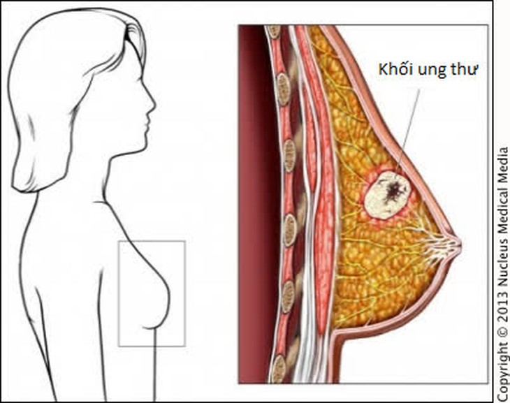 Chế độ dinh dưỡng giúp bệnh nhân ung thư vú nhanh hồi phục sức khỏe - Ảnh 2.