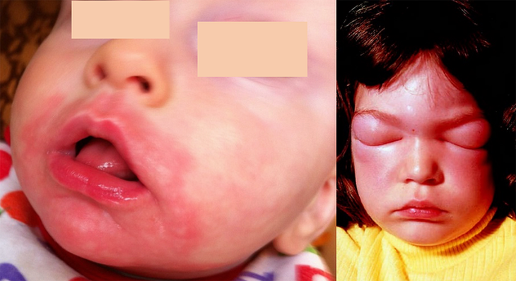 Dị ứng sữa bò ở trẻ em: Triệu chứng và cách xử trí - Ảnh 4.
