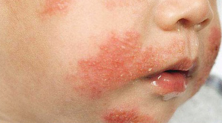 Dị ứng sữa bò ở trẻ em: Triệu chứng và cách xử trí - Ảnh 3.